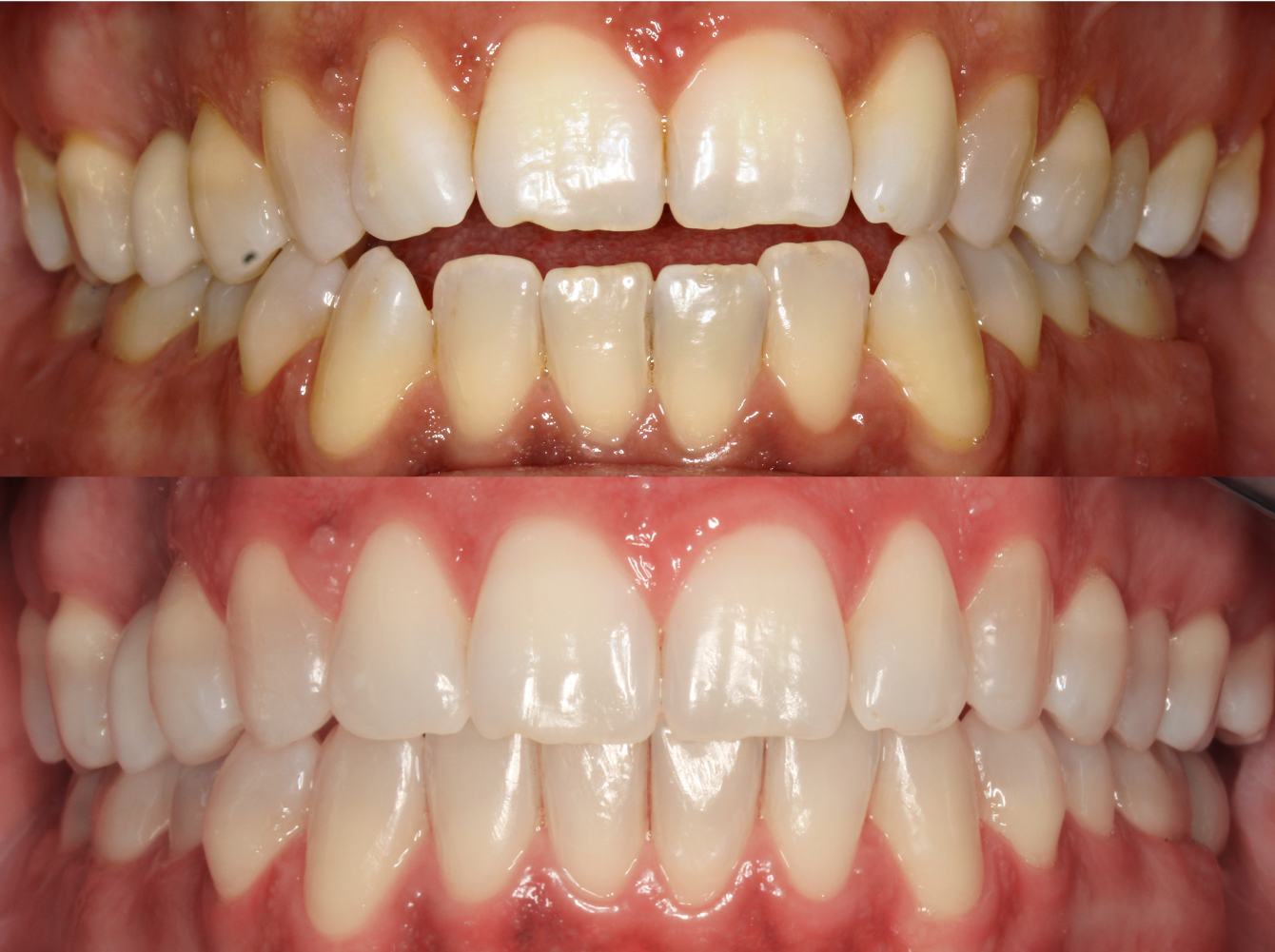 img-antesydesp-invisalign