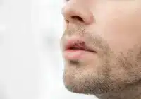 Que es un herpes labial