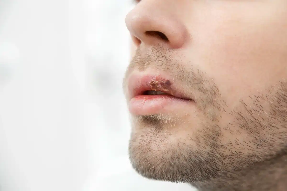 Herpes labial: causas y tratamiento