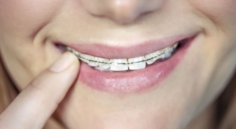 Brackets-o-Invisalign-min