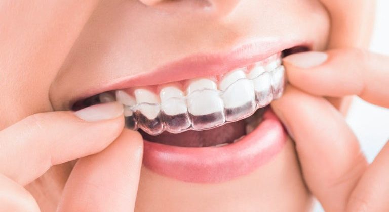 Clinica-Dental-Oviedo-Invisalign-768x509-min