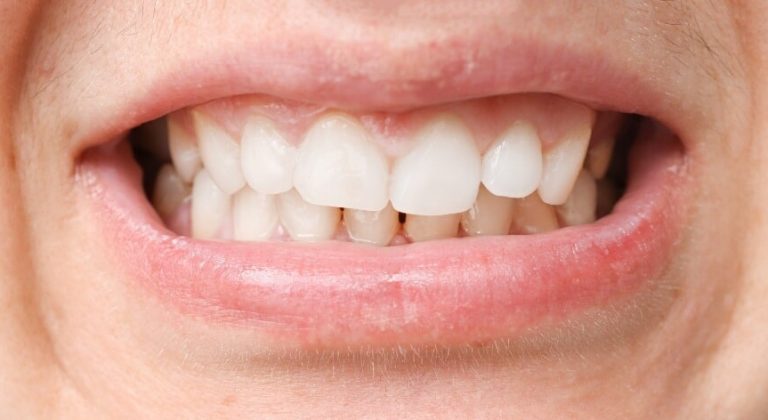 Como-se-hace-el-curetaje-dental-y-que-beneficios-tiene-1