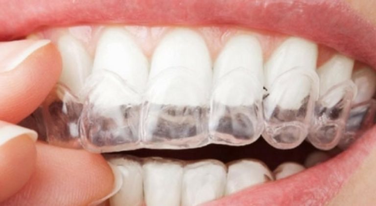 Implantes-con-invisalign