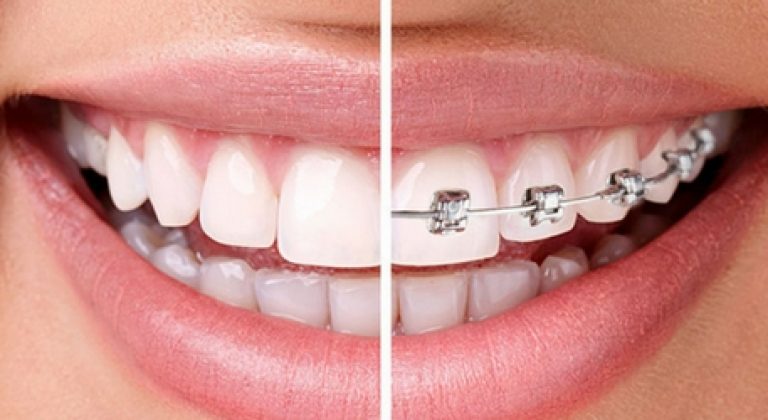 Invisalign-Brackets-1