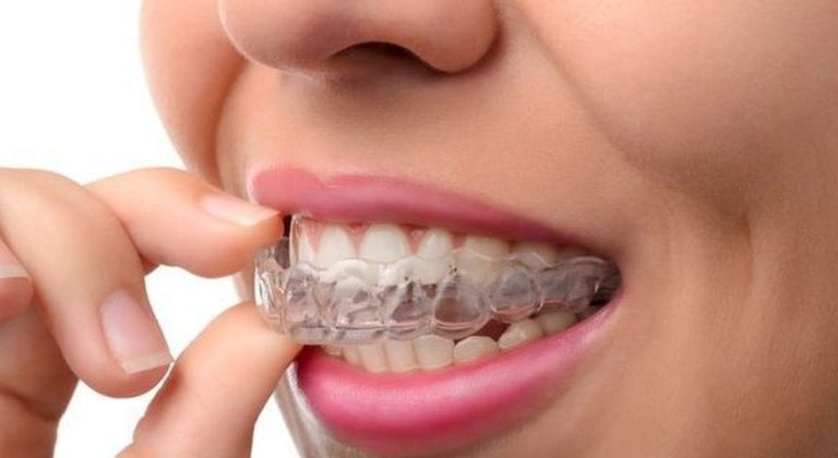 Invisalign-min-1