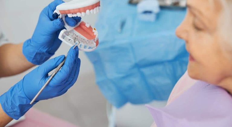 Precio-de-los-implantes-dentales-para-toda-la-boca-en-2022