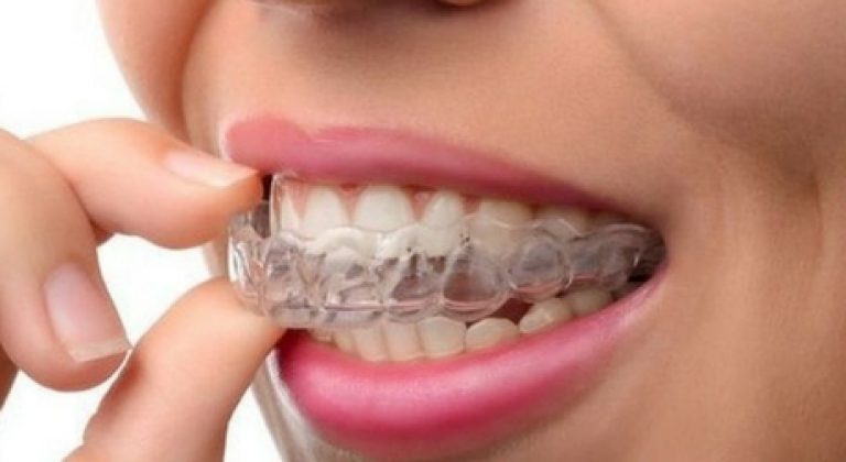 Que-es-Invisalign