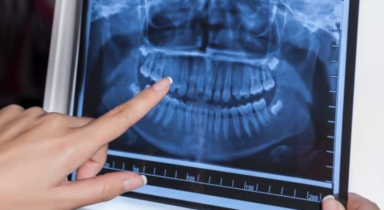 cuantas-radiografias-dentales-se-pueden-hacer-al-ano-sin-riesgos