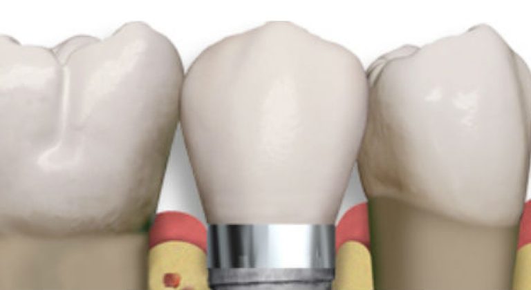 implantes-dentales-1