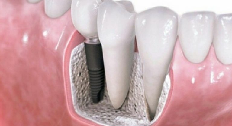 implantes-dentales-en-un-dia-1