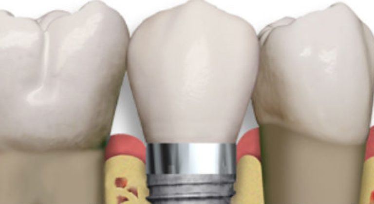 implantes-dentales